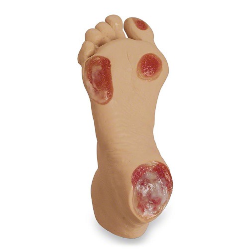 Life/form Elderly Pressure Ulcer Foot